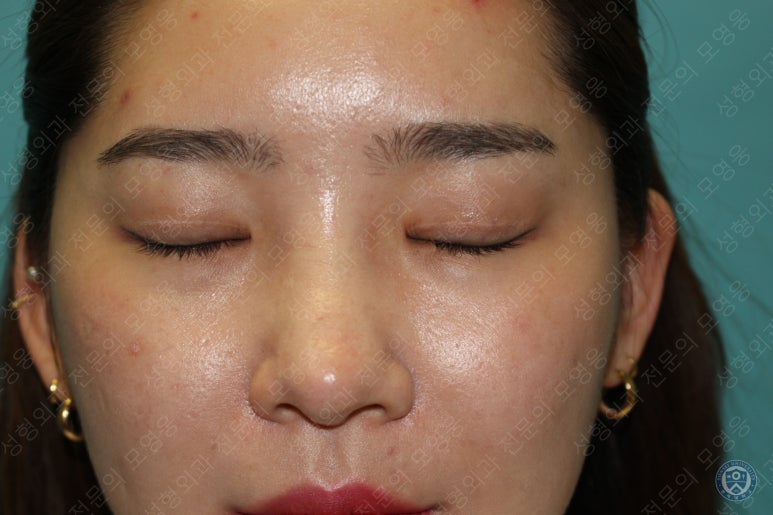28세 여성 두줄따기, 눈밑지(28/F D.E.O & transconjunctival septal fat redraping) 관련 이미지 4