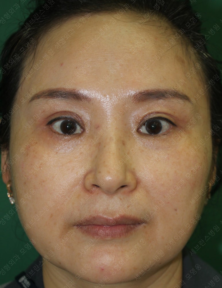 49세 여성, 토안이 있는 중년여성의 상안검성형술 (49/F, Upper blepharoplasty with lagophthalmos correction& LP) 관련 이미지 24