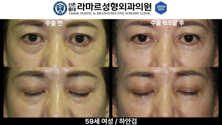 30대~80대 눈 수술 케이스 : 하안검성형술 전후 사진 모음 관련 이미지 47