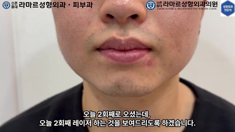 개에 물려 입술 1/3이 뜯긴 19세 남자분 치료 및 흉터 성형수술& 레이저 후기....! 관련 이미지 50