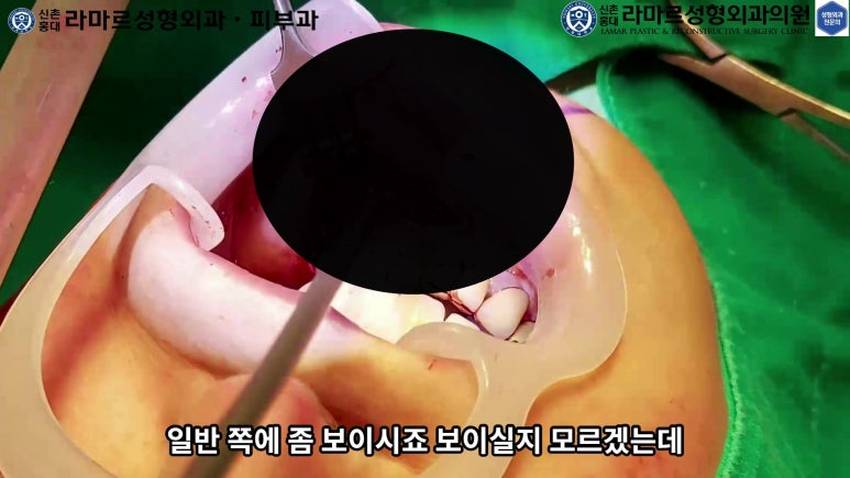파라핀 필러 입 안 절개로 흉터없이 빼내기! 관련 이미지 25