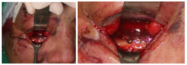 57세 남성, 얼굴 전체골절(57/M Panfacial bone fracture) 수술 및 흉터관리 증례 관련 이미지 11