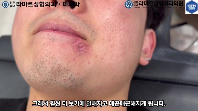 개에 물려 입술 1/3이 뜯긴 19세 남자분 치료 및 흉터 성형수술& 레이저 후기....! 관련 이미지 82