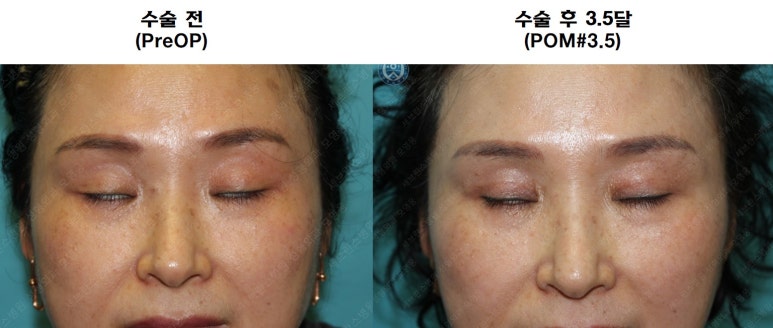 49세 여성, 토안이 있는 중년여성의 상안검성형술 (49/F, Upper blepharoplasty with lagophthalmos correction& LP) 관련 이미지 42