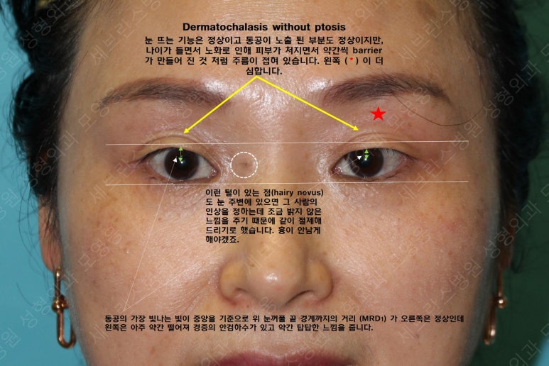 49세 여성, 토안이 있는 중년여성의 상안검성형술 (49/F, Upper blepharoplasty with lagophthalmos correction& LP) 관련 이미지 10