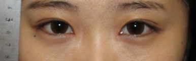 17세 여성, 쌍꺼풀+앞트임(DEO+Medial epicanthoplasty) 관련 이미지 25