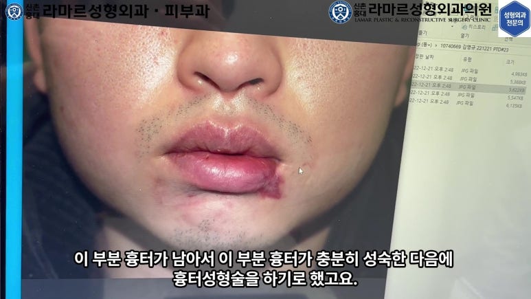 개에 물려 입술 1/3이 뜯긴 19세 남자분 치료 및 흉터 성형수술& 레이저 후기....! 관련 이미지 32