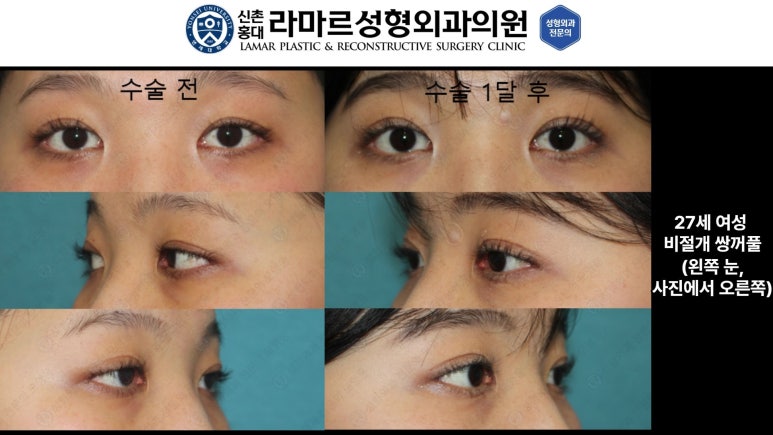 10대~30대 눈 수술 케이스 : 대표원장님 쌍꺼풀 전후 사진 모음 관련 이미지 20