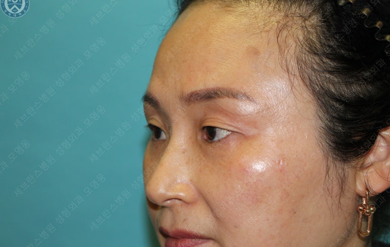 49세 여성, 토안이 있는 중년여성의 상안검성형술 (49/F, Upper blepharoplasty with lagophthalmos correction& LP) 관련 이미지 7