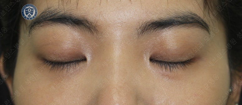 28세 여성, 눈밑지방재배치(눈밑지, 28/F Transconjunctival septal fat redraping-internal fixation technique) 관련 이미지 24