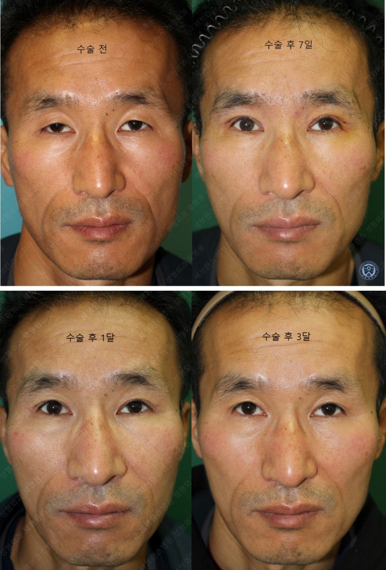 남자눈성형: 무쌍눈매교정 (Blephroptosis correction-levator aponeurosis advancement) 관련 이미지 47