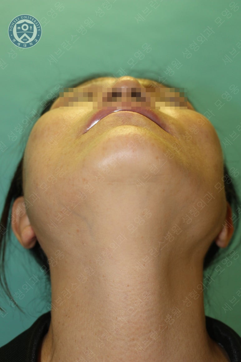 55세 여성, 이중평면 안면거상(55/F, Dual-plane full facelift) 관련 이미지 41