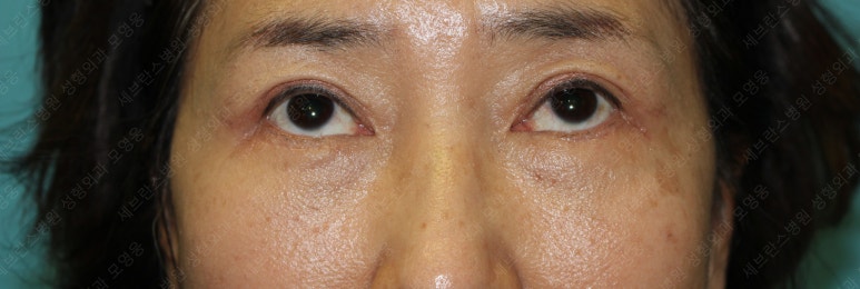 55세 여성, 상안검 및 하안검 성형술 증례 (55/F Upper & lower blepharoplasty) 관련 이미지 22