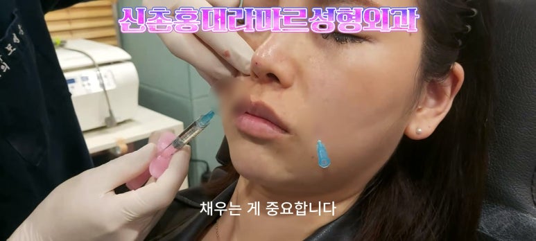 30대 여성 팔자필러 시술: 팔자주름과 안전이별 하는 법 관련 이미지 5