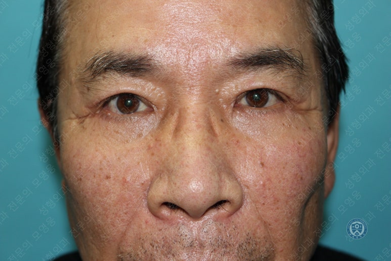 67세 남성, 상&middot;하안검성형술 및 안검하수교정 (67/M, Upper &  lower blepharoplasty with ptosis correction) 관련 이미지 37