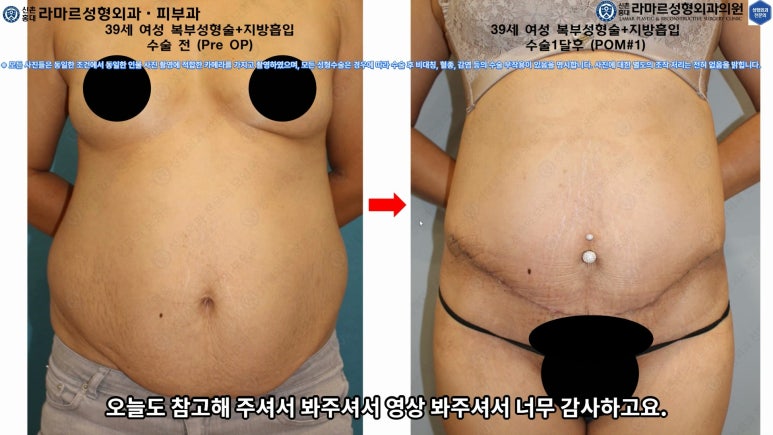 '복부성형술+지방흡입(Abdominoplasty+PAL)' 으로 뱃살 끝장내기! 관련 이미지 62