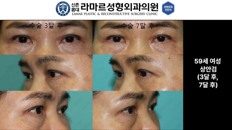 40대~80대 눈 수술 케이스 : 상안검성형술 전후 사진 모음 관련 이미지 19