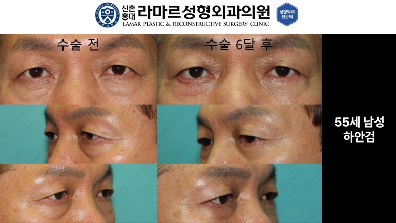 30대~80대 눈 수술 케이스 : 하안검성형술 전후 사진 모음 관련 이미지 29