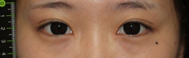 17세 여성, 쌍꺼풀+앞트임(DEO+Medial epicanthoplasty) 관련 이미지 33