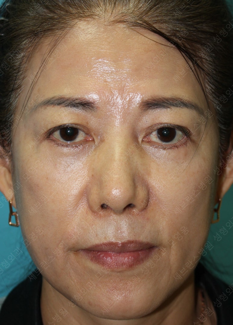 59세 여성, 그레이브스 안병증이 있는 돌출눈 중년 여성 하안검 성형술 (Lower blepharoplasty in Graves 관련 이미지 33