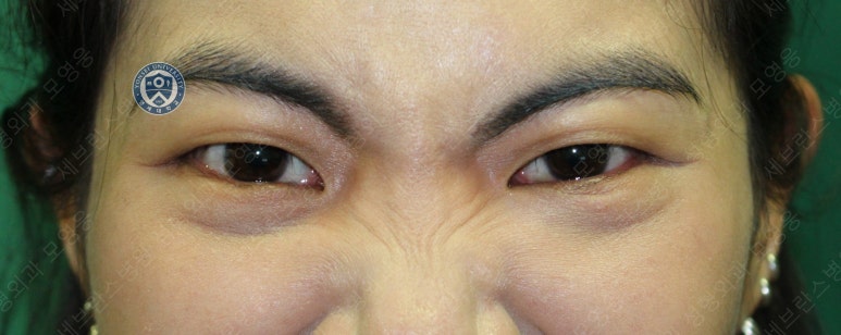 28세 여성, 눈밑지방재배치(눈밑지, 28/F Transconjunctival septal fat redraping-internal fixation technique) 관련 이미지 21