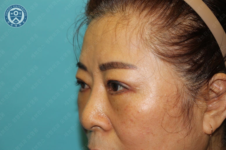 60세 여성, 상안검 및 하안검 성형술 증례 (60/F Upper & lower blepharoplasty) 관련 이미지 18