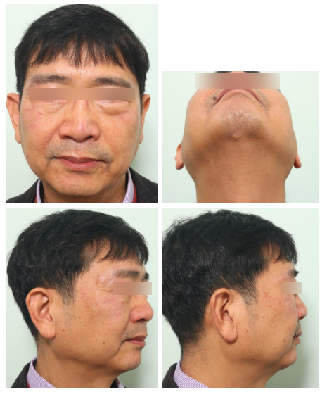 57세 남성, 얼굴 전체골절(57/M Panfacial bone fracture) 수술 및 흉터관리 증례 관련 이미지 17