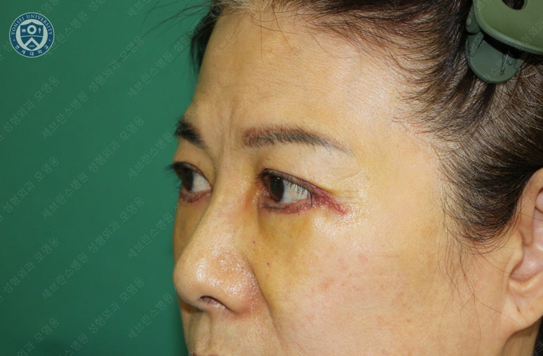 59세 여성, 그레이브스 안병증이 있는 돌출눈 중년 여성 하안검 성형술 (Lower blepharoplasty in Graves 관련 이미지 14
