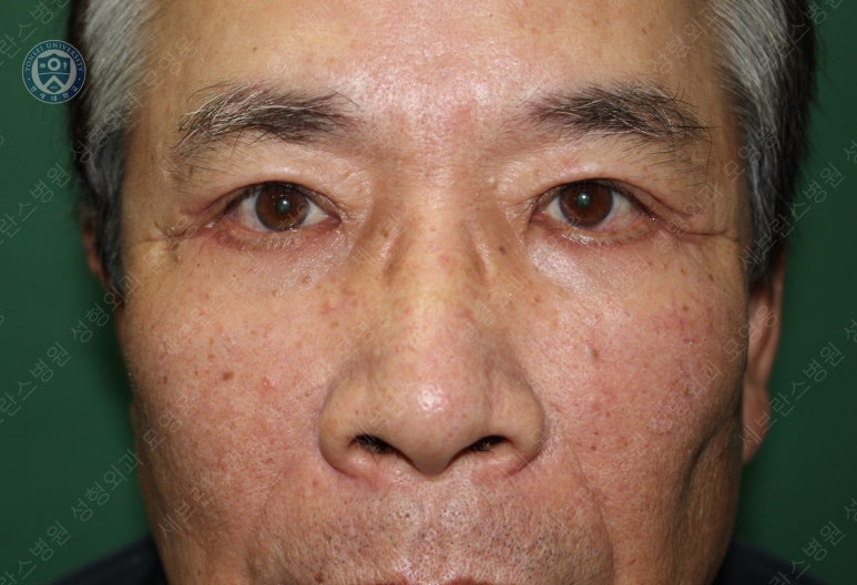 67세 남성, 상&middot;하안검성형술 및 안검하수교정 (67/M, Upper &  lower blepharoplasty with ptosis correction) 관련 이미지 29