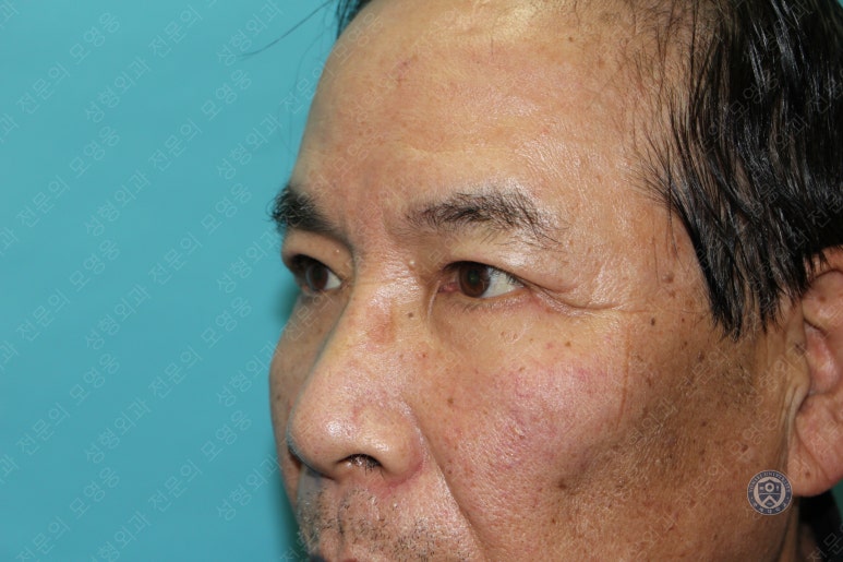 67세 남성, 상&middot;하안검성형술 및 안검하수교정 (67/M, Upper &  lower blepharoplasty with ptosis correction) 관련 이미지 41