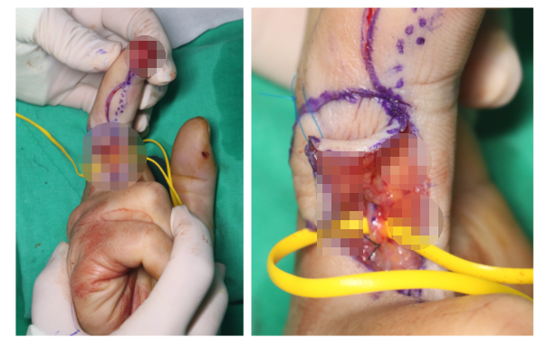 수지 말단부 절단에 시행한 동측 역행성 유경피판술 증례 (Homodigital Reverse Island Flap for Fingertip Amputation) 관련 이미지 5
