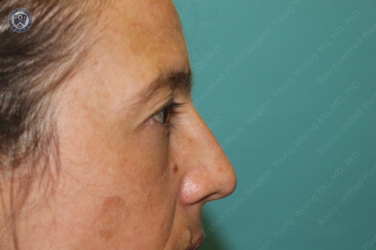 38세 서양 백인 여성, 쌍꺼풀 수술과 눈매교정 및 하안검성형술 (38/F Upper&lower blepharoplasty with levator plication) 관련 이미지 9