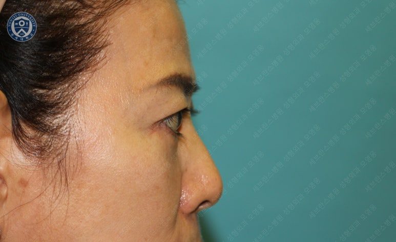 59세 여성, 그레이브스 안병증이 있는 돌출눈 중년 여성 하안검 성형술 (Lower blepharoplasty in Graves 관련 이미지 32