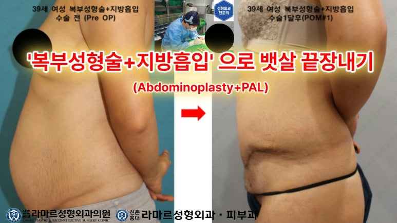 '복부성형술+지방흡입(Abdominoplasty+PAL)' 으로 뱃살 끝장내기! 관련 이미지 6