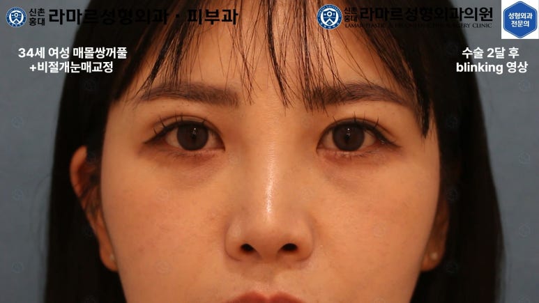 30대 여성 "쌍꺼풀+눈매교정" 상담, 디자인, 수술 전체 과정, 결과, 경과 모두 공개합니다. 관련 이미지 45