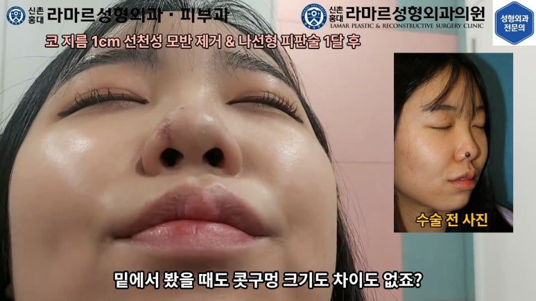 지름 1cm 코 점 제거수술 : 나선피판술(Spiral Flap) 수술전~1달 경과. (Feat. 턱끝필러+사각턱 보톡스) 관련 이미지 157