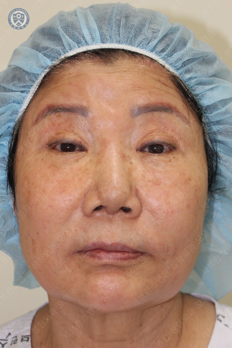 71세 여성, 이마거상술과 이마축소술 (71/F, Forehead lift and reduction) 관련 이미지 10