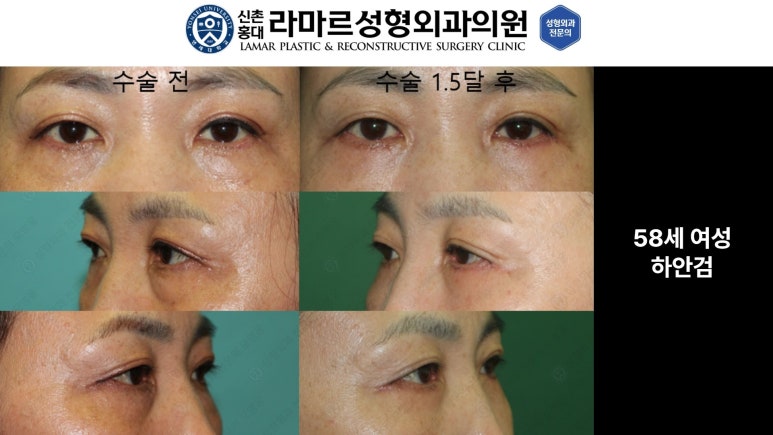 30대~80대 눈 수술 케이스 : 하안검성형술 전후 사진 모음 관련 이미지 30
