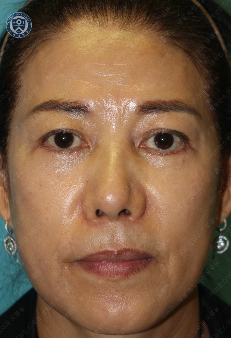 59세 여성, 그레이브스 안병증이 있는 돌출눈 중년 여성 하안검 성형술 (Lower blepharoplasty in Graves 관련 이미지 25