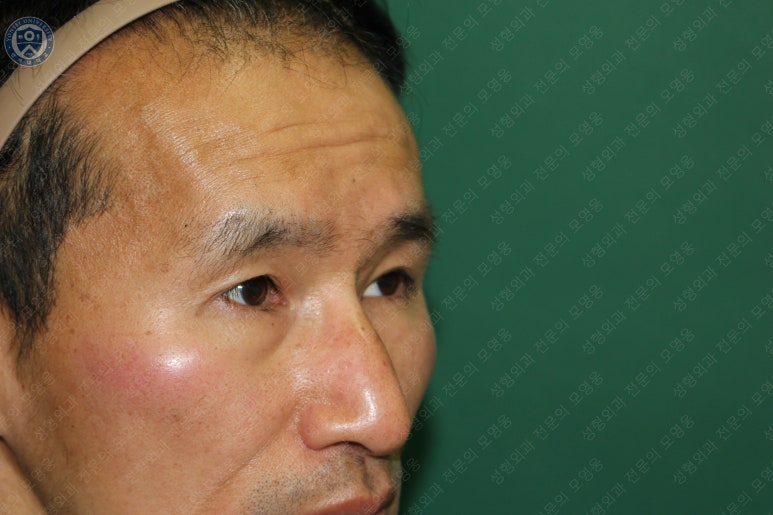 남자눈성형: 무쌍눈매교정 (Blephroptosis correction-levator aponeurosis advancement) 관련 이미지 43