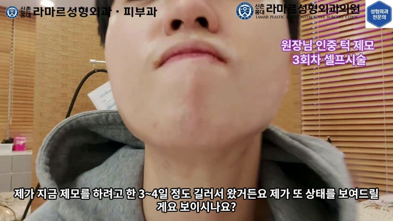 [성형외과 전문의의 셀프시술 제8편] 인중, 아래턱 제모 4회차 결과 공개! 관련 이미지 37