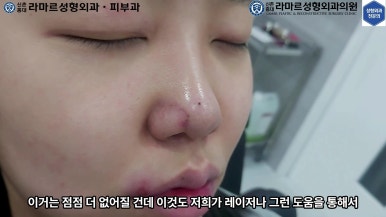 21세 여성 코 지름 1cm 점 제거수술 : 나선피판술(Spiral Flap) 수술전~5달 경과. (+쌍꺼풀수술, 코필러) 관련 이미지 23