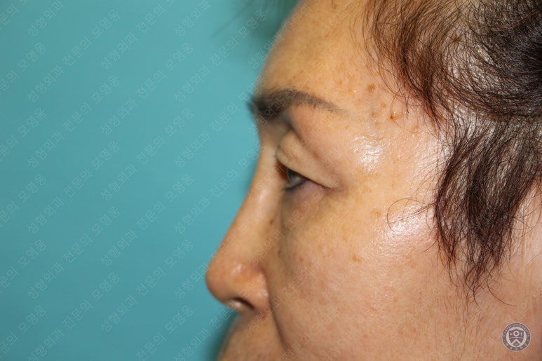 64세 여성 상안검성형술+눈매교정 (64/F Upper blepharoplasty with ptosis correction) 관련 이미지 6