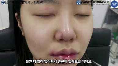 21세 여성 코 지름 1cm 점 제거수술 : 나선피판술(Spiral Flap) 수술전~5달 경과. (+쌍꺼풀수술, 코필러) 관련 이미지 24