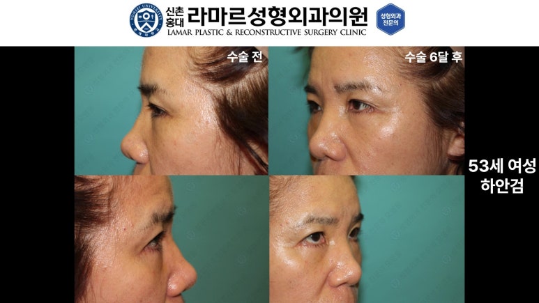 30대~80대 눈 수술 케이스 : 하안검성형술 전후 사진 모음 관련 이미지 34
