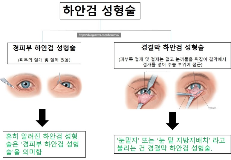 28세 여성, 눈밑지방재배치(눈밑지, 28/F Transconjunctival septal fat redraping-internal fixation technique) 관련 이미지 2