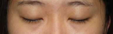 17세 여성, 쌍꺼풀+앞트임(DEO+Medial epicanthoplasty) 관련 이미지 10