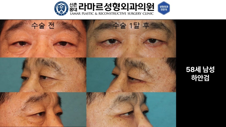 30대~80대 눈 수술 케이스 : 하안검성형술 전후 사진 모음 관련 이미지 11