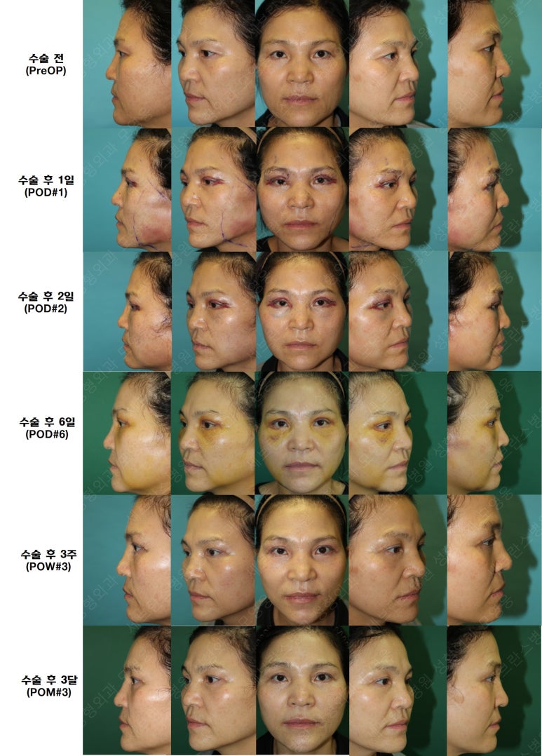 55세 여성, 이중평면 안면거상(55/F, Dual-plane full facelift) 관련 이미지 65