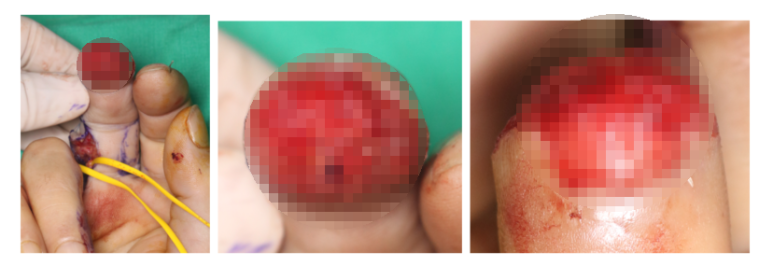 수지 말단부 절단에 시행한 동측 역행성 유경피판술 증례 (Homodigital Reverse Island Flap for Fingertip Amputation) 관련 이미지 6